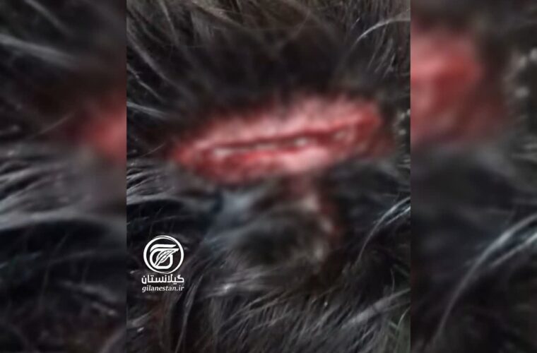 دانش‌آموز مجروح لوشانی با فرق سر شکافته در پی ضربه صندلی آهنی همکلاسی در کلاس درس دبیرستان ولیعصر
